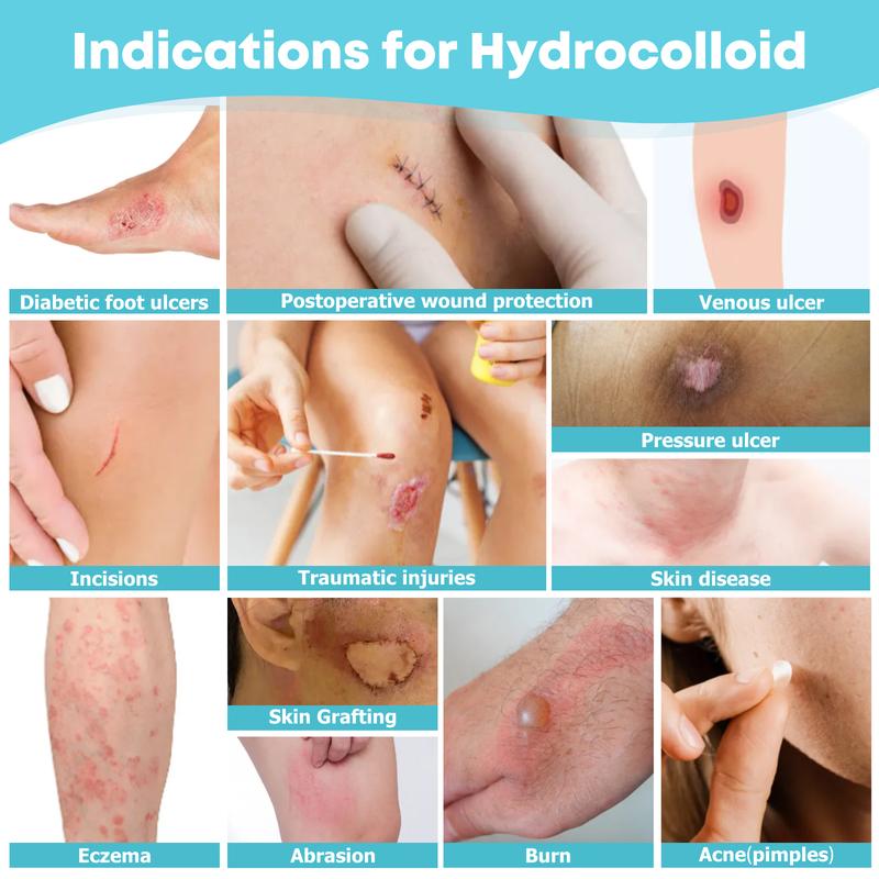 Mozy™ Hydrocolloid Roll – Professional Wound Care