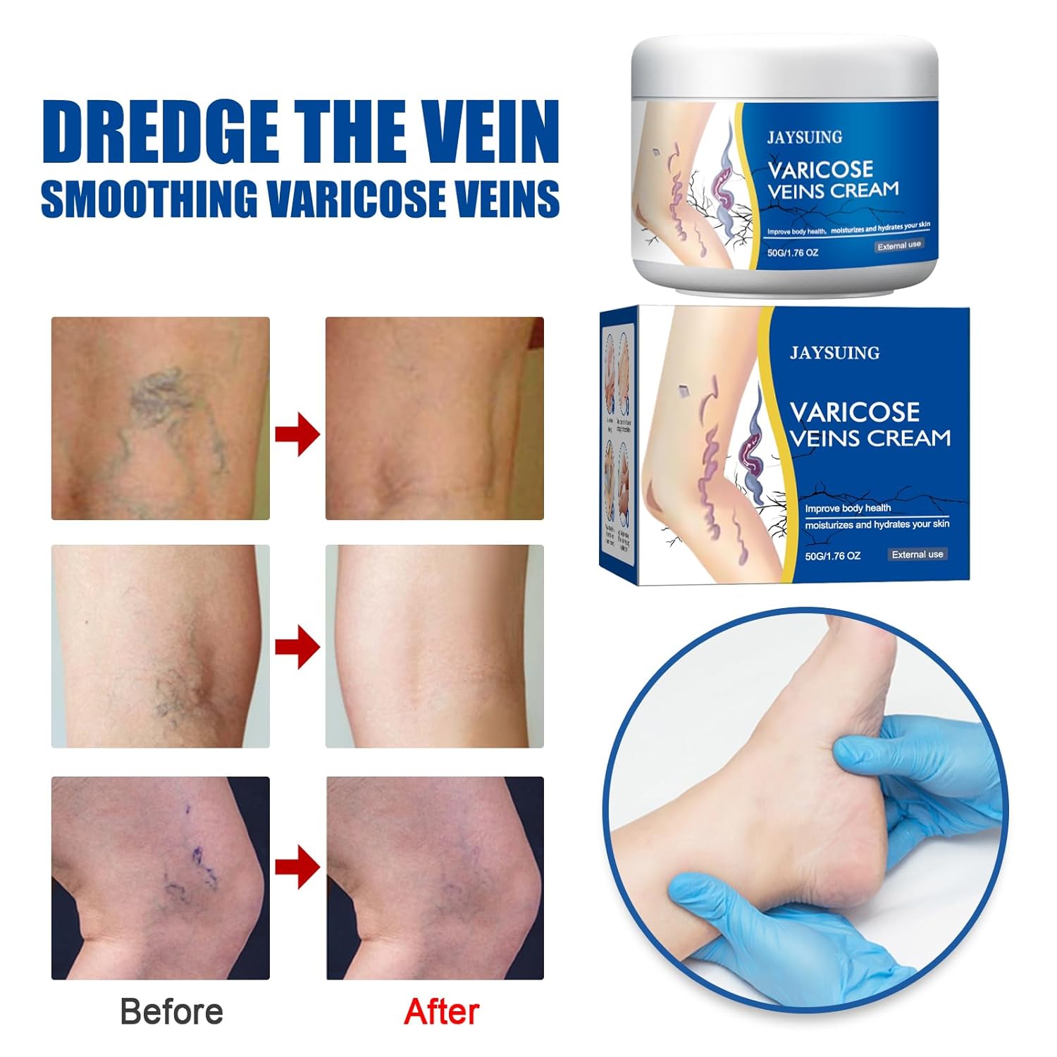 Advertisement for JAYSUING Varicose Veins Cream showing before and after effects on varicose veins.