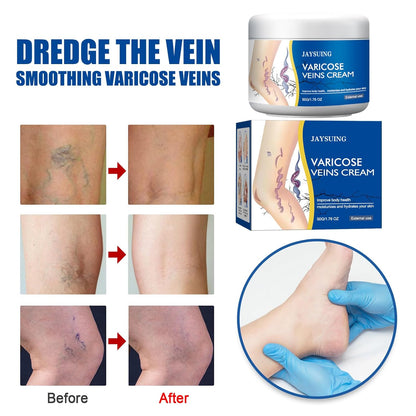 Advertisement for JAYSUING Varicose Veins Cream showing before and after effects on varicose veins.
