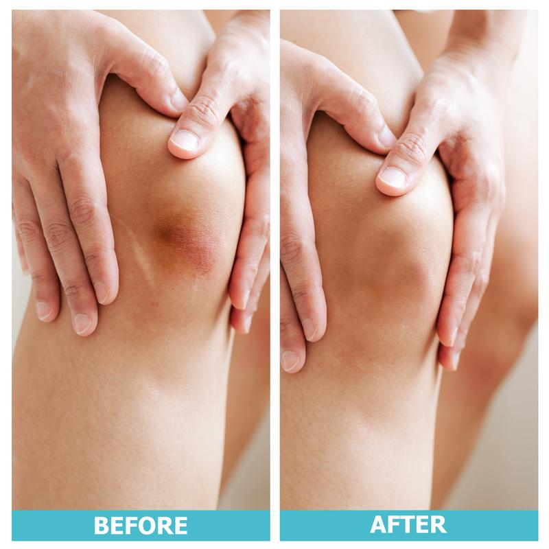 Mozy™ Hydrocolloid Roll – Professional Wound Care